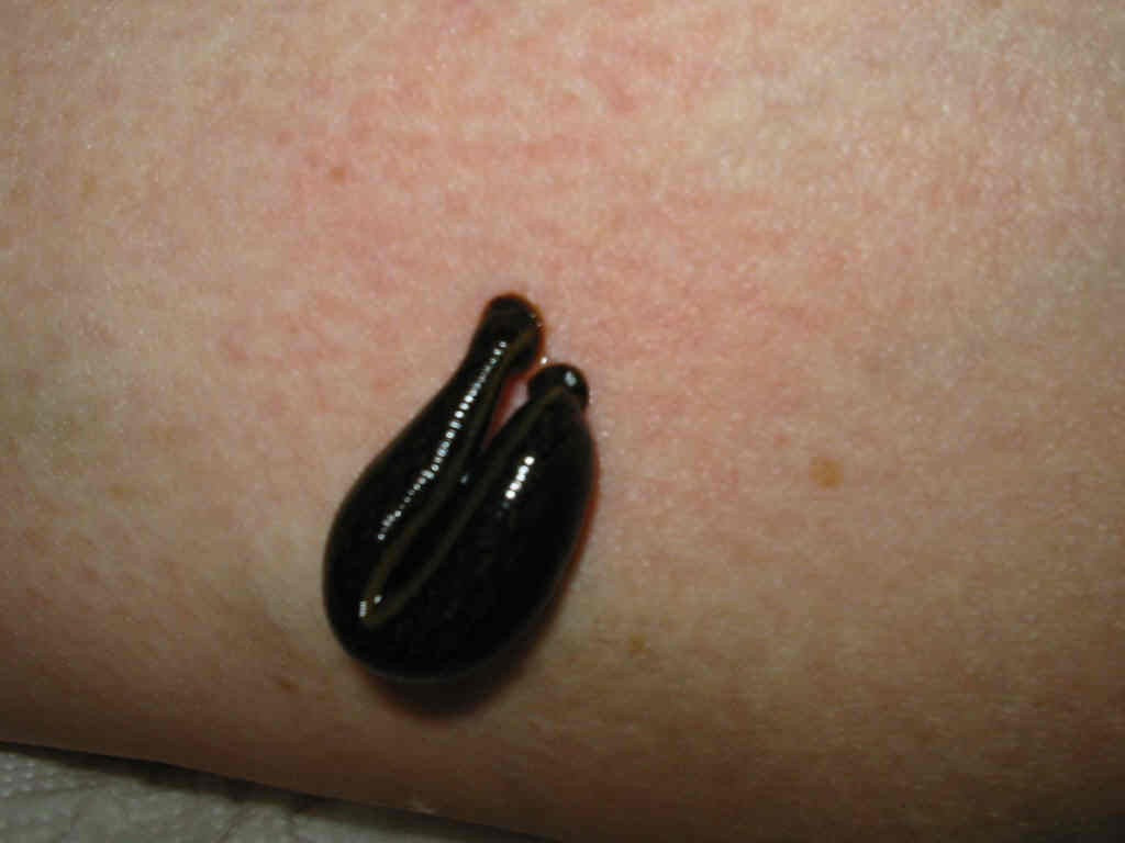 Leeches in Asian medicine
